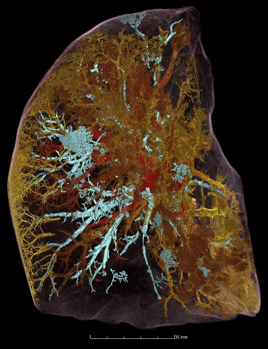 Imagem HiP-CT do lobo pulmonar intacto de um homem de 54 anos, vítima de covid-19. Em vermelho, estão os vasos sanguíneos abertos. Em amarelo, os vasos sanguíneos bloqueados. Em ciano, os espaços aéreos - Divulgação