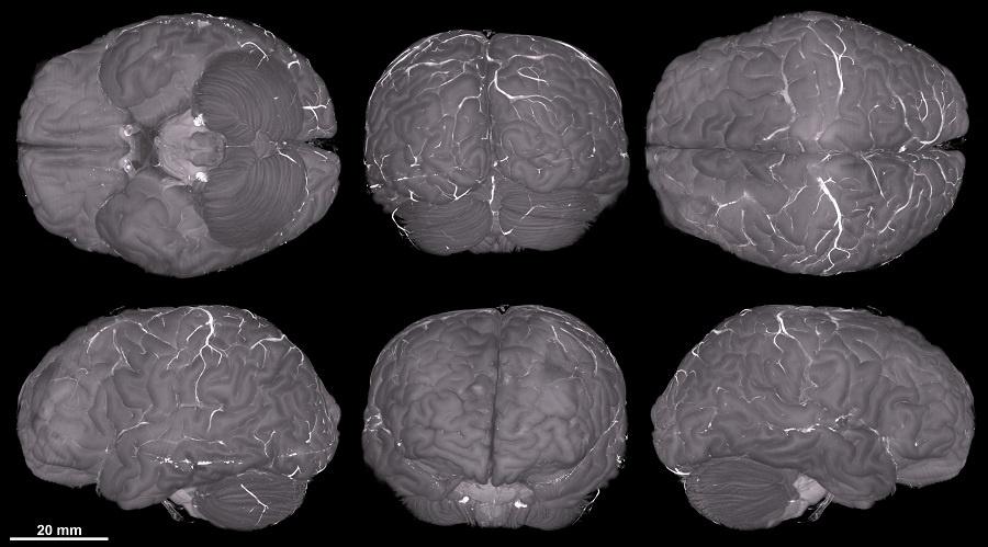 Cérebro de uma mulher de 69 anos, imagem feita por HiP-CT. - Divulgação