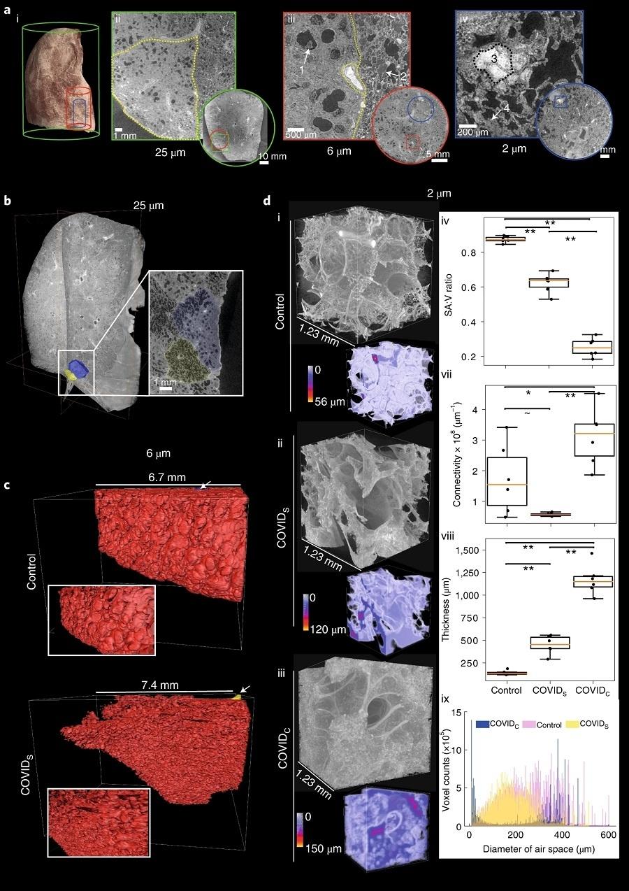 HiP-CT com análise de imagem 3D e morfometria no pulmão de um paciente com covid-19 - Divulgação